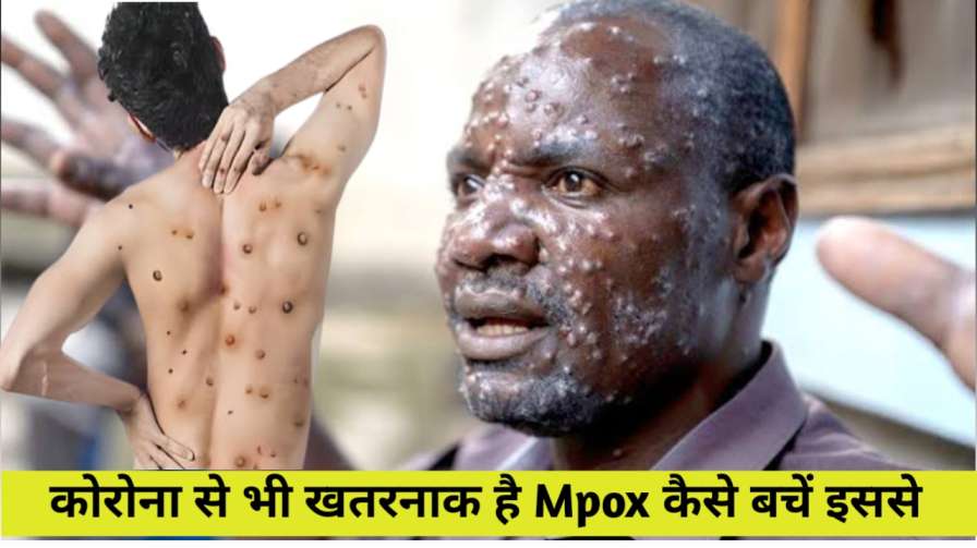 mpox